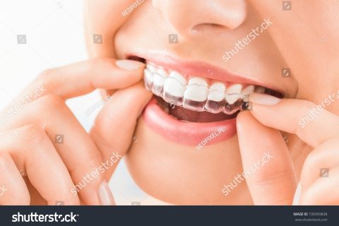 INVISALIGN